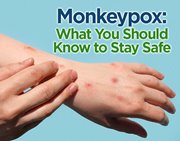 Monkeypox: What You Should Know to Stay Safe