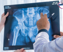 Hip Treatment and Replacement Fort Myers 