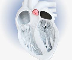 Heart Valve Center