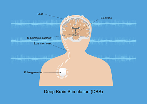 Deep Brain Stilumation Diagram