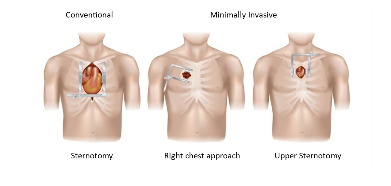 Minimally invasive valve repair- Lee Health